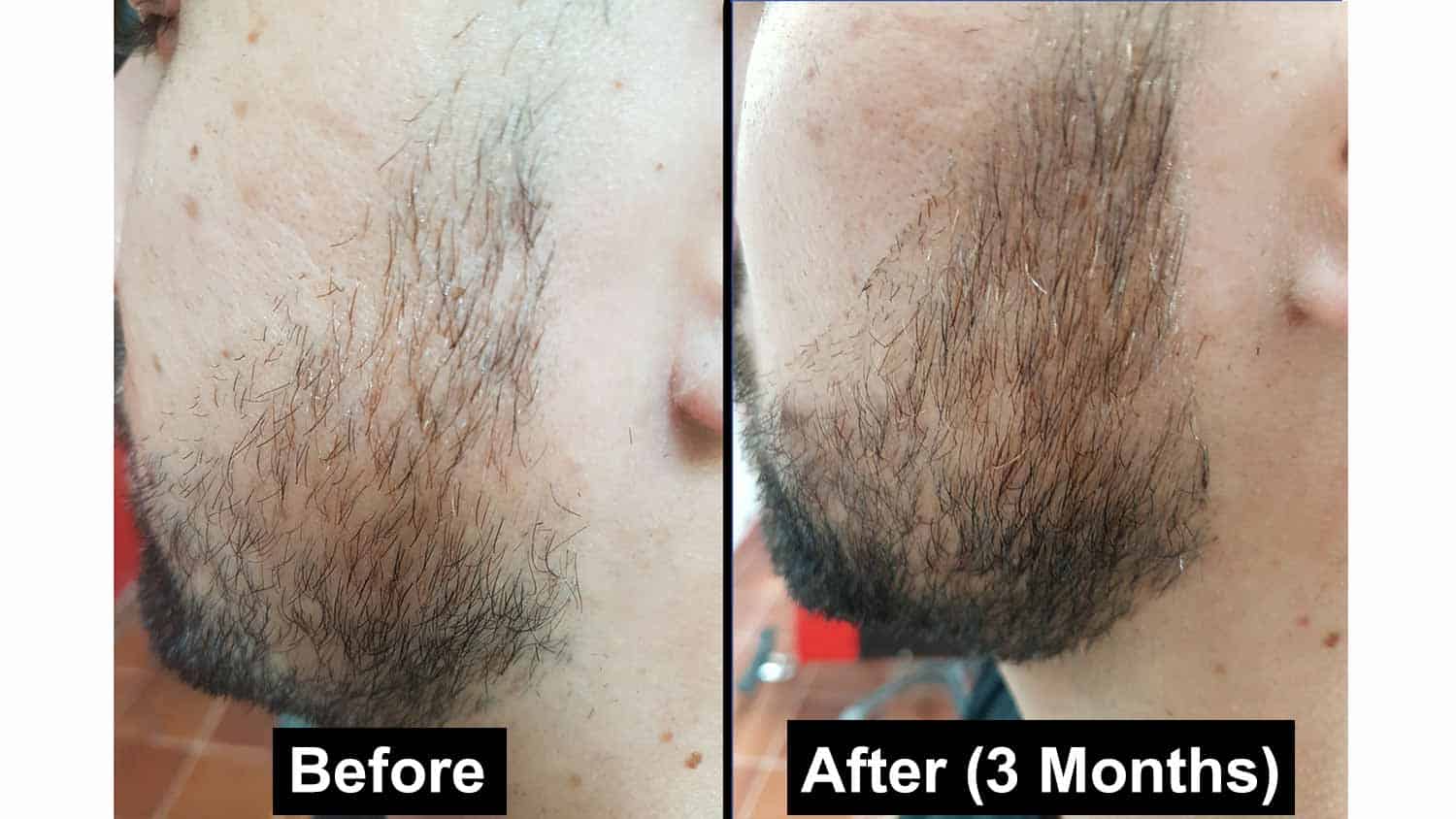 Beard rogaine bald spots for Definitive Guide