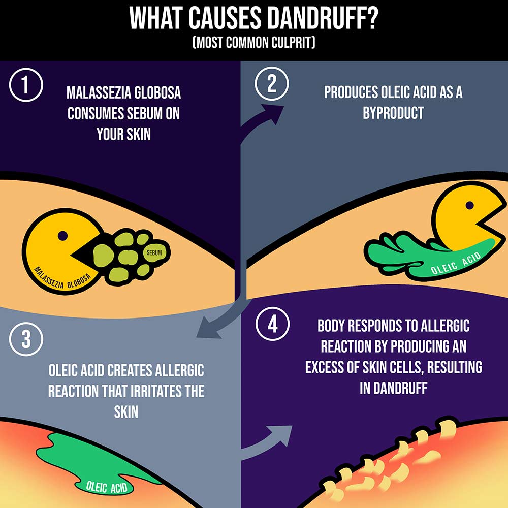 What causes Beard Dandruff