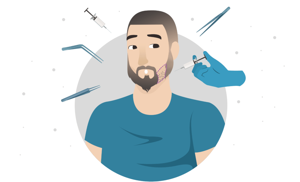 Beard Transplants: Simple things You Need to Know 3